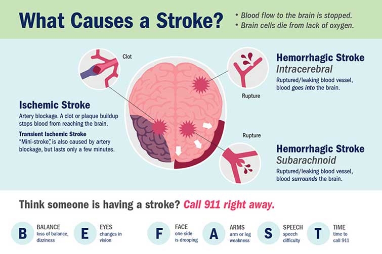 Brain Stroke Types Causes Symptoms Prevention And 50 OFF
