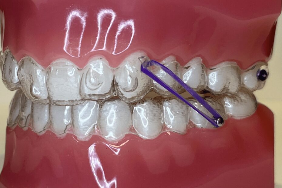 Elastics Marin Ortho Orthodontist Larkspur Bay Area