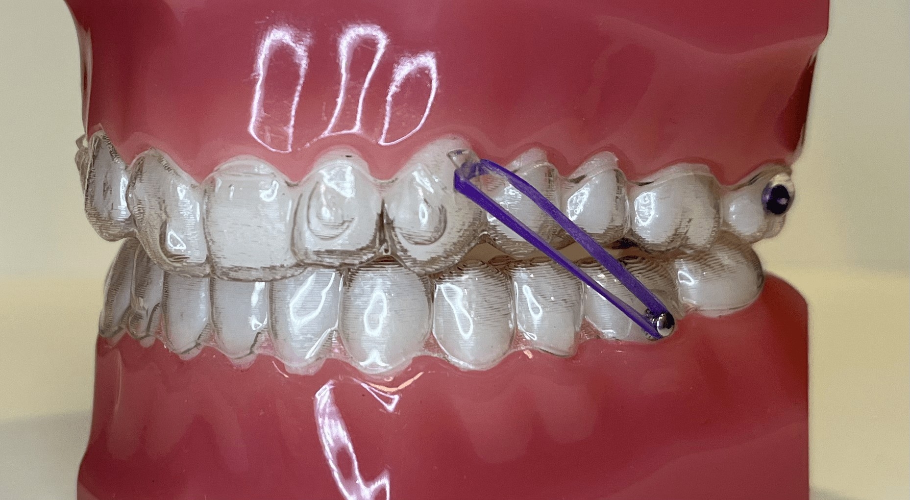 Elastics Marin Ortho Orthodontist Larkspur Bay Area