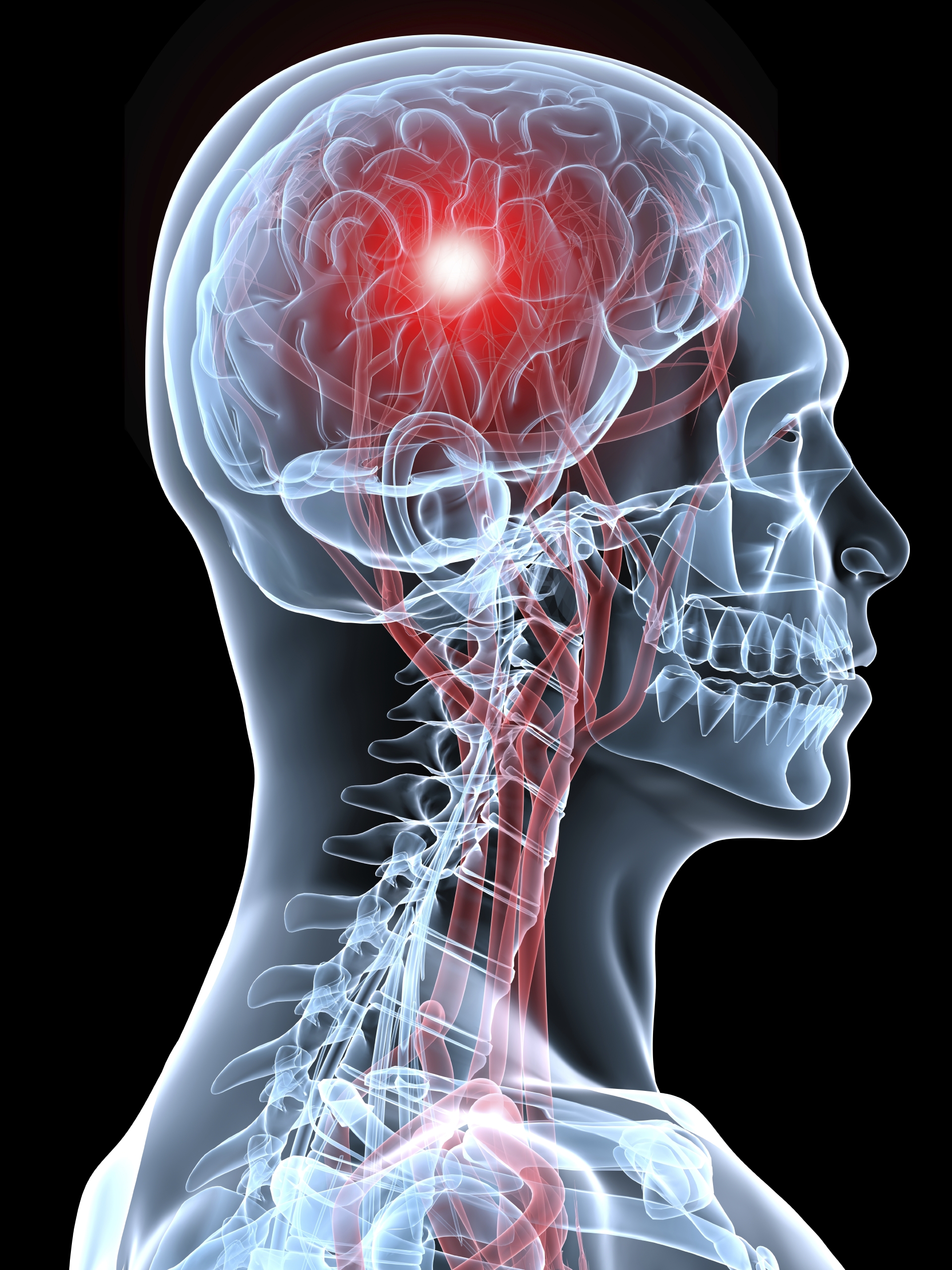 Health Tips Stroke Treatments Toxic Chemicals In Receipts And New 