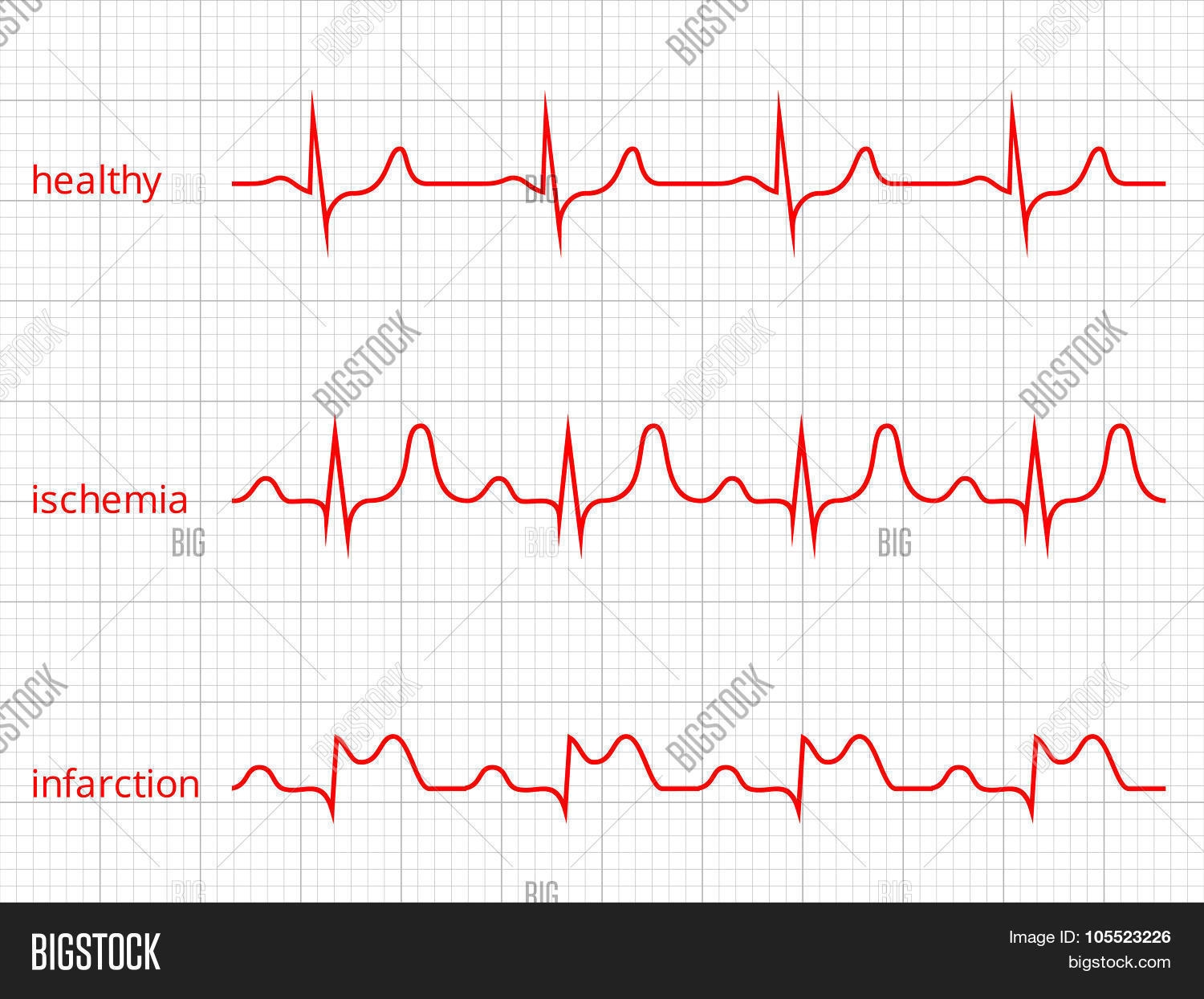 Heart Beat Chart Heart Cardiogram Chart Vector Set Healthy Heart Rhythm