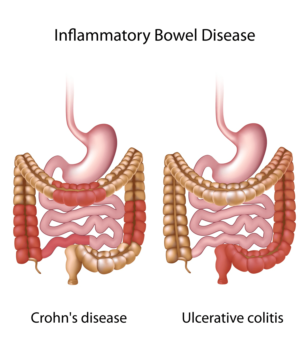 bowel stool chart bowel stool chart