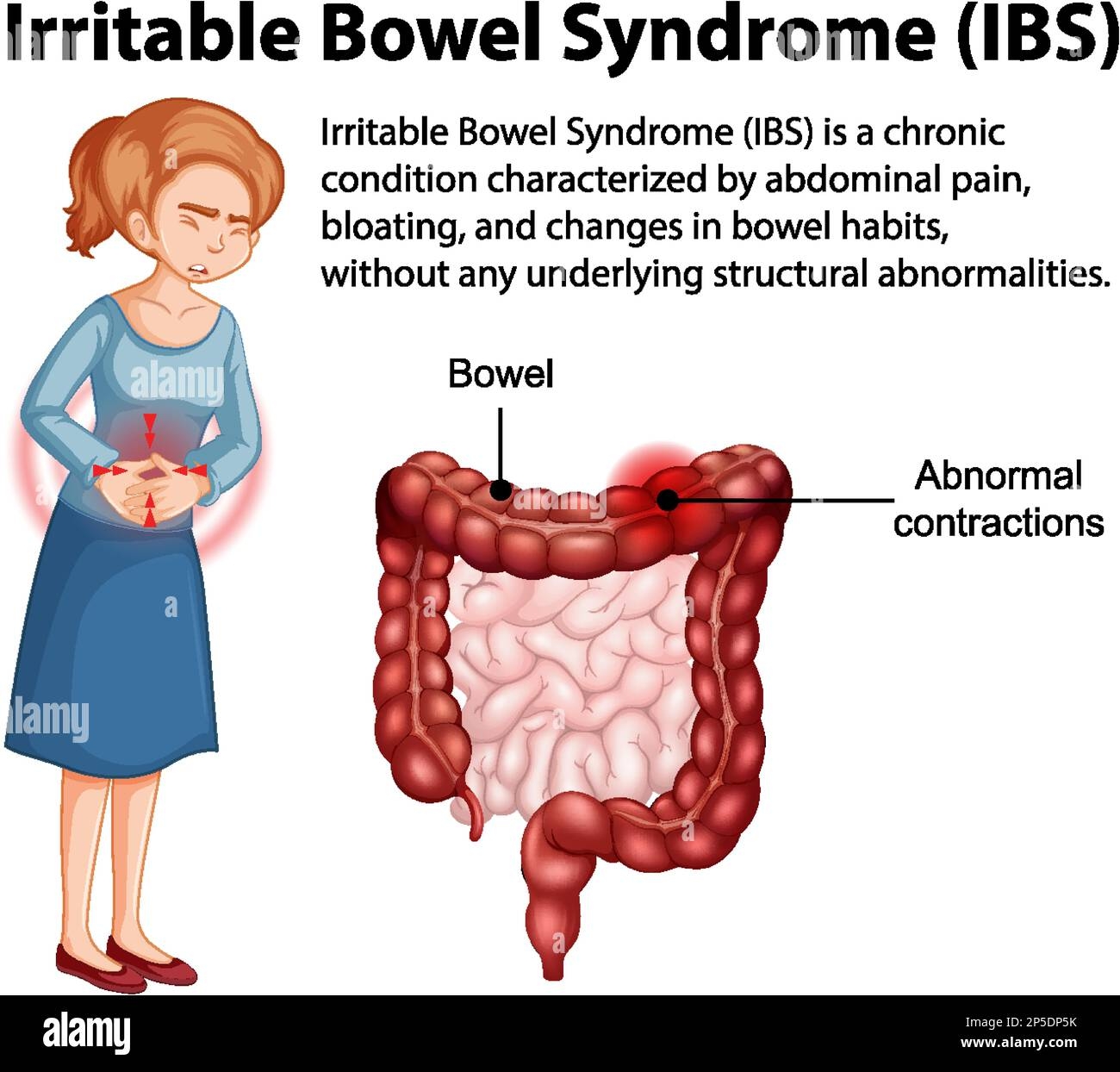 Irritable Bowel Syndrome IBS Infographic Illustration Stock Vector 