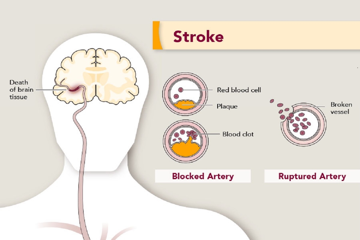 Stroke Causes Symptoms Diagnosis And Treatment