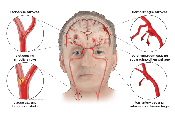 Stroke Definition Causes Symptoms Treatment And MCQs For NEET GPAT 